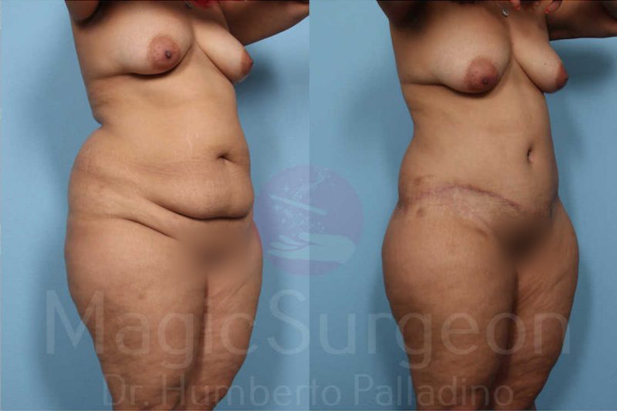 Tummy Tuck Before & After Gallery - Patient 133182339 - Image 5