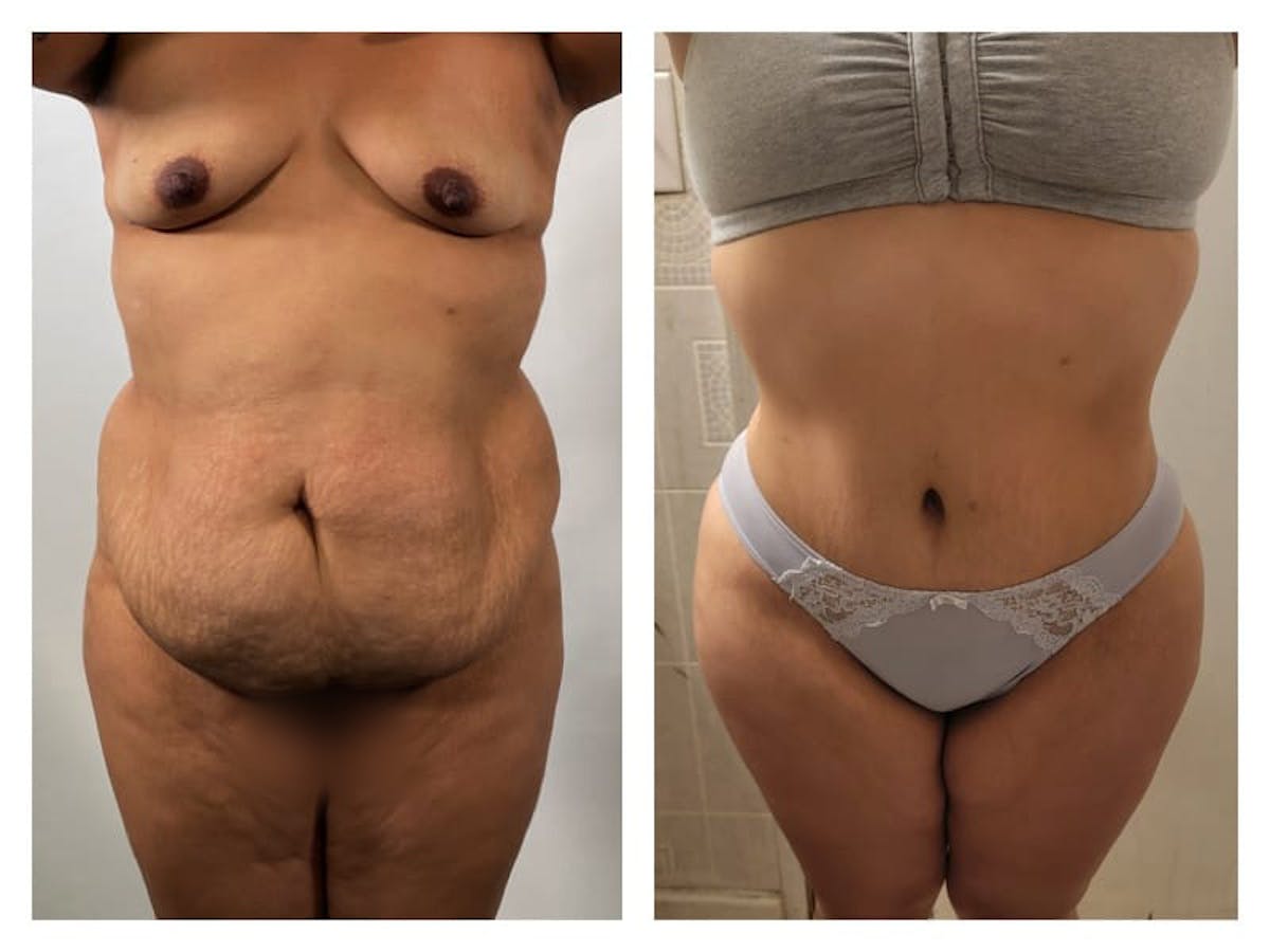 Liposuction Before & After Gallery - Patient 133183860 - Image 1