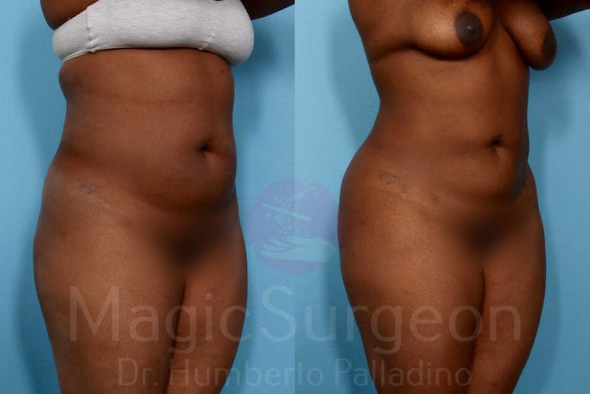 Liposuction Before & After Gallery - Patient 133182306 - Image 2
