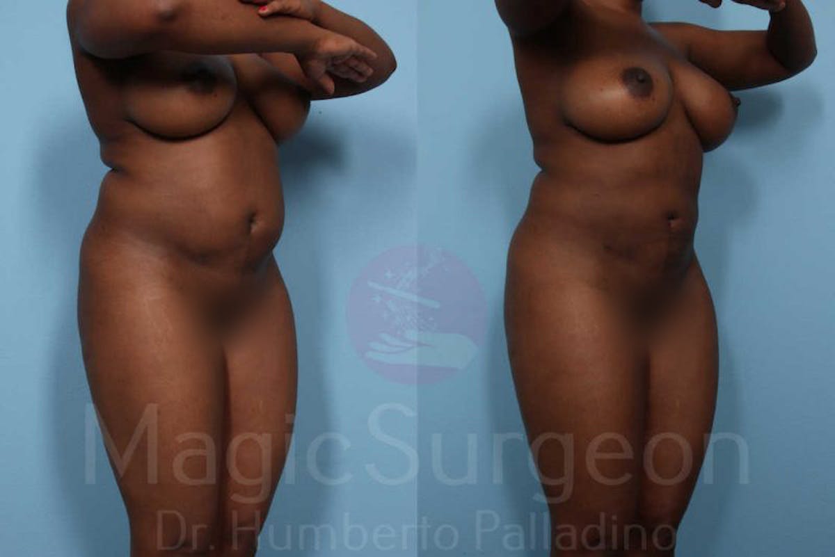 Liposuction Before & After Gallery - Patient 133182310 - Image 4