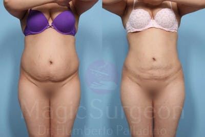 Liposuction Before & After Gallery - Patient 133182315 - Image 1