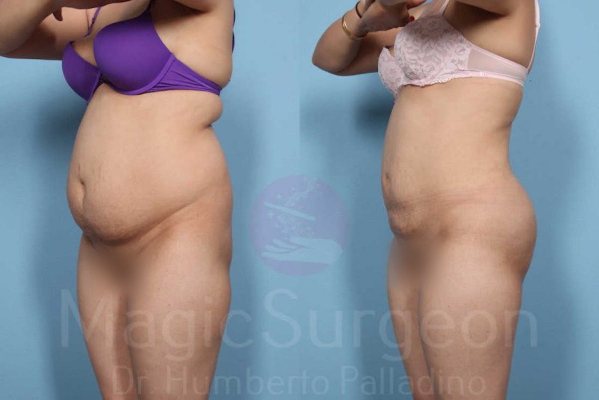 Liposuction Before & After Gallery - Patient 133182315 - Image 2