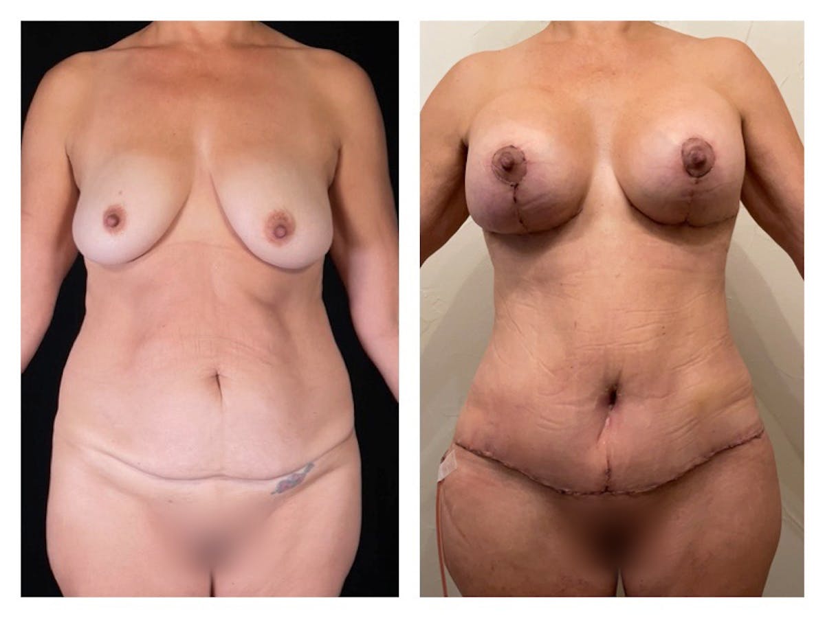 Breast Augmentation Before & After Gallery - Patient 291942 - Image 1