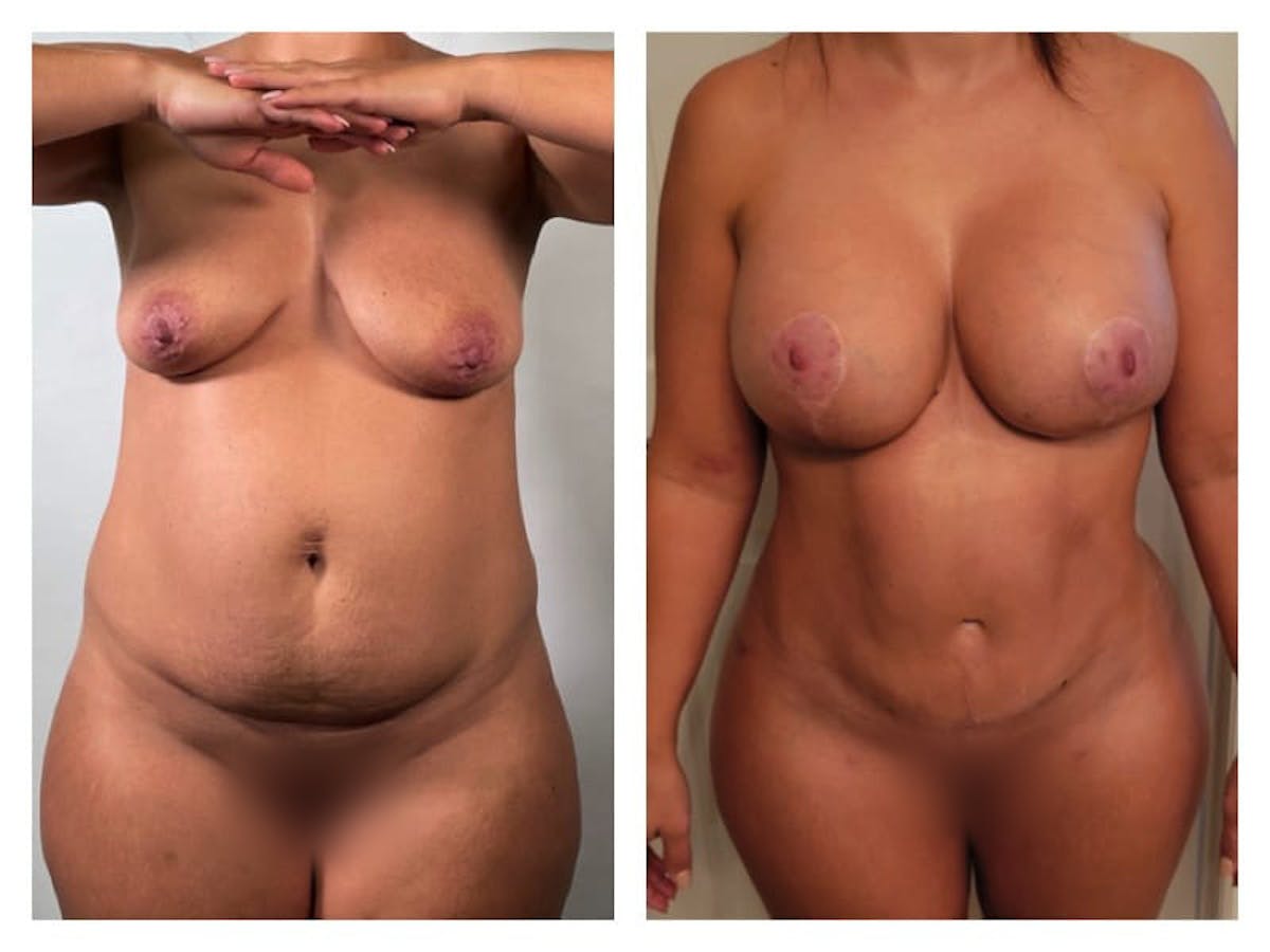 Breast Augmentation Before & After Gallery - Patient 133183847 - Image 1