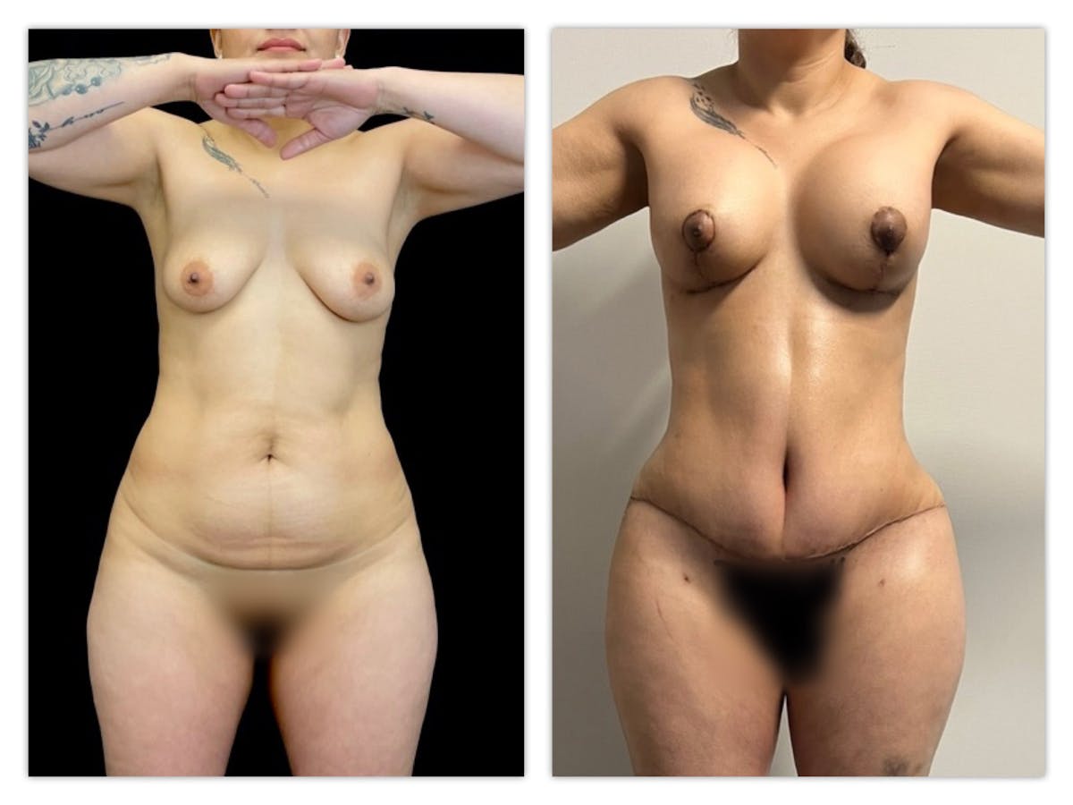 Breast Augmentation Before & After Gallery - Patient 182055 - Image 1