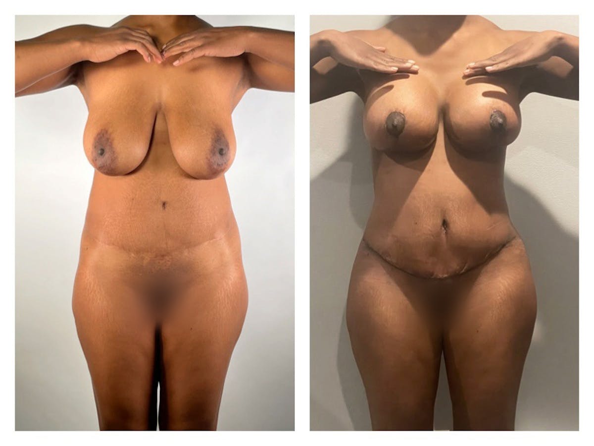 Breast Augmentation Before & After Gallery - Patient 365282 - Image 1