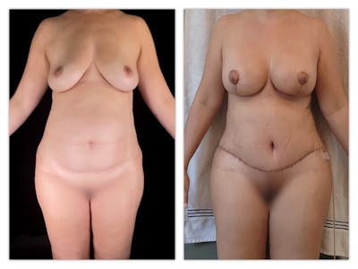 Breast Augmentation Before & After Gallery - Patient 115255 - Image 1