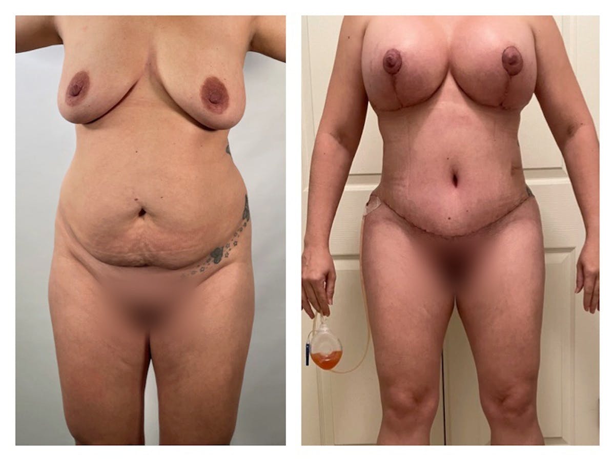 Breast Augmentation Before & After Gallery - Patient 308889 - Image 1