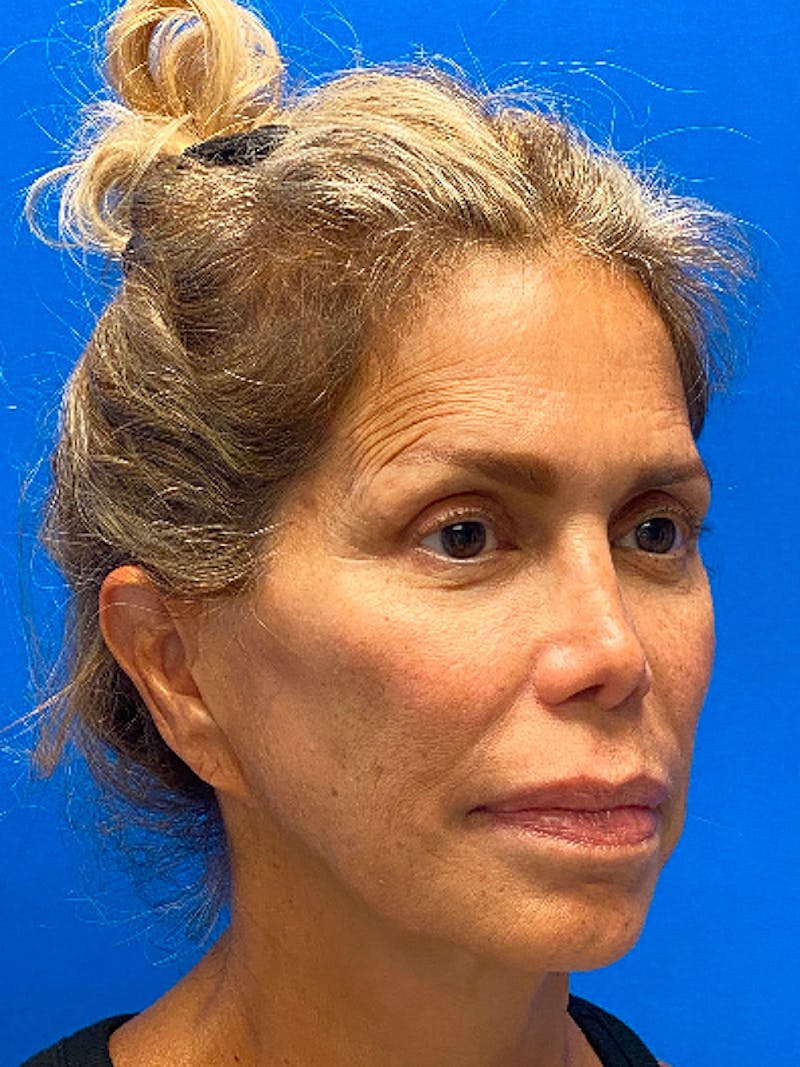 Facelift Before & After Gallery - Patient 122921130 - Image 3