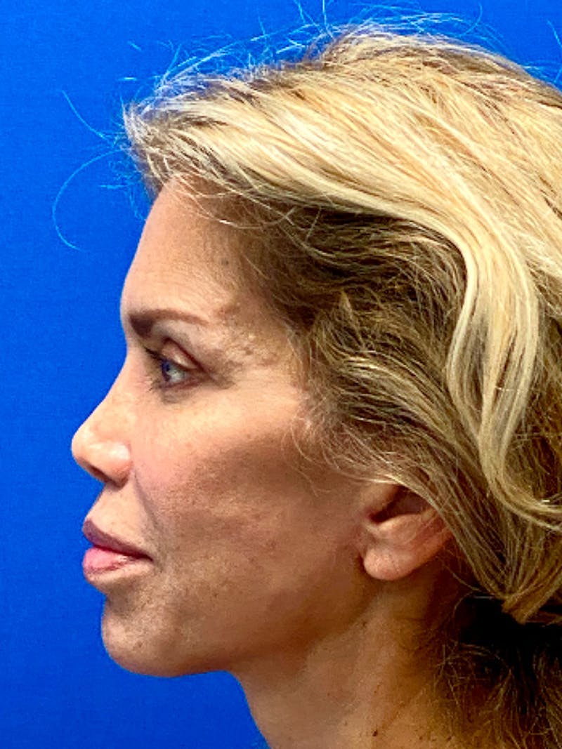 Facelift Before & After Gallery - Patient 122921130 - Image 6