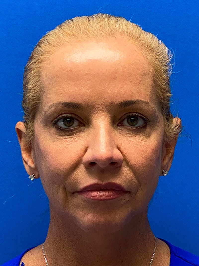 Facelift Before & After Gallery - Patient 122921259 - Image 1
