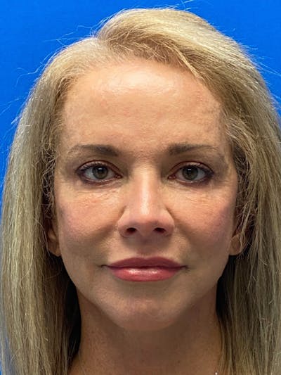 Facelift Before & After Gallery - Patient 122921259 - Image 2