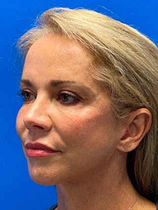 Facelift Before & After Gallery - Patient 122921259 - Image 4