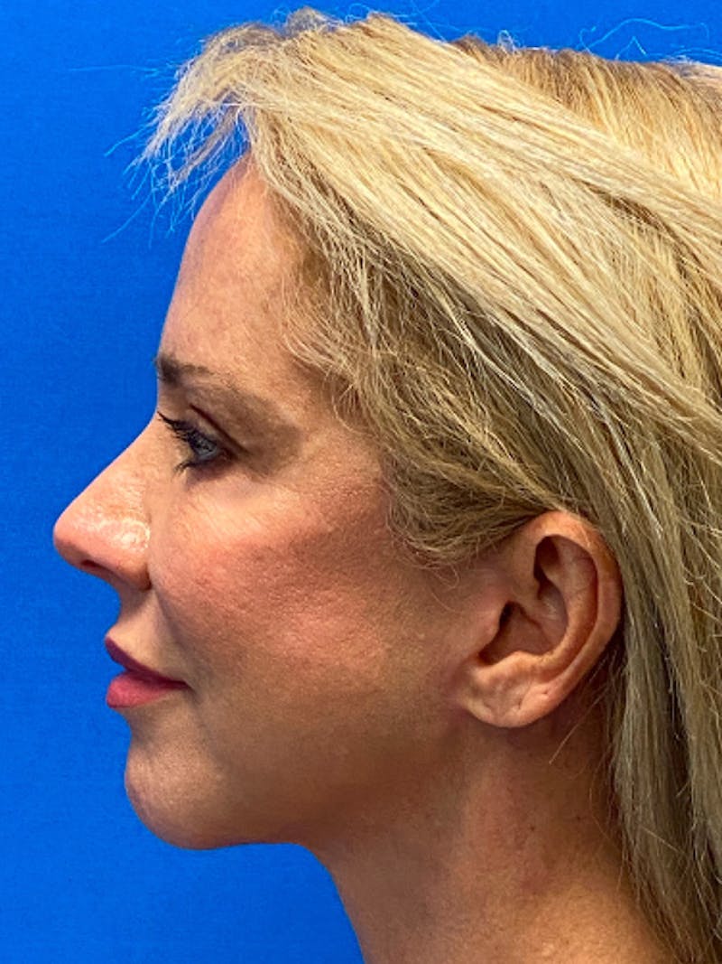 Facelift Before & After Gallery - Patient 122921259 - Image 6
