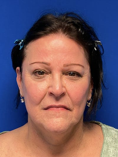 Facelift Before & After Gallery - Patient 122921304 - Image 1