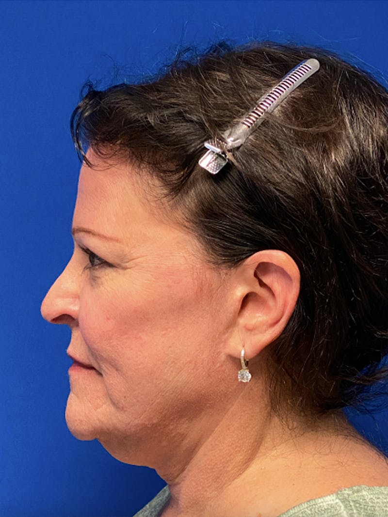 Facelift Before & After Gallery - Patient 122921304 - Image 5