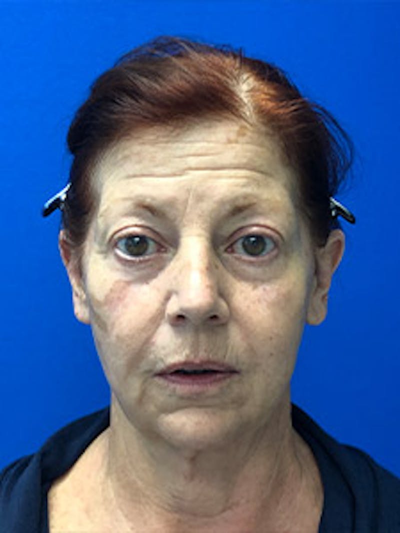 Facelift Before & After Gallery - Patient 122921320 - Image 1