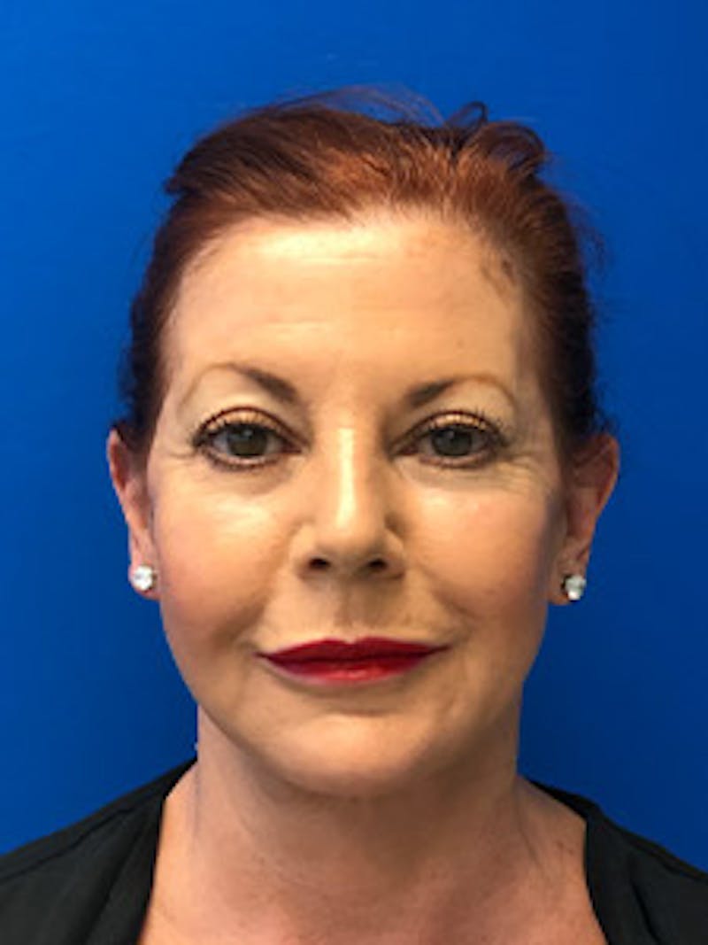 Facelift Before & After Gallery - Patient 122921320 - Image 2