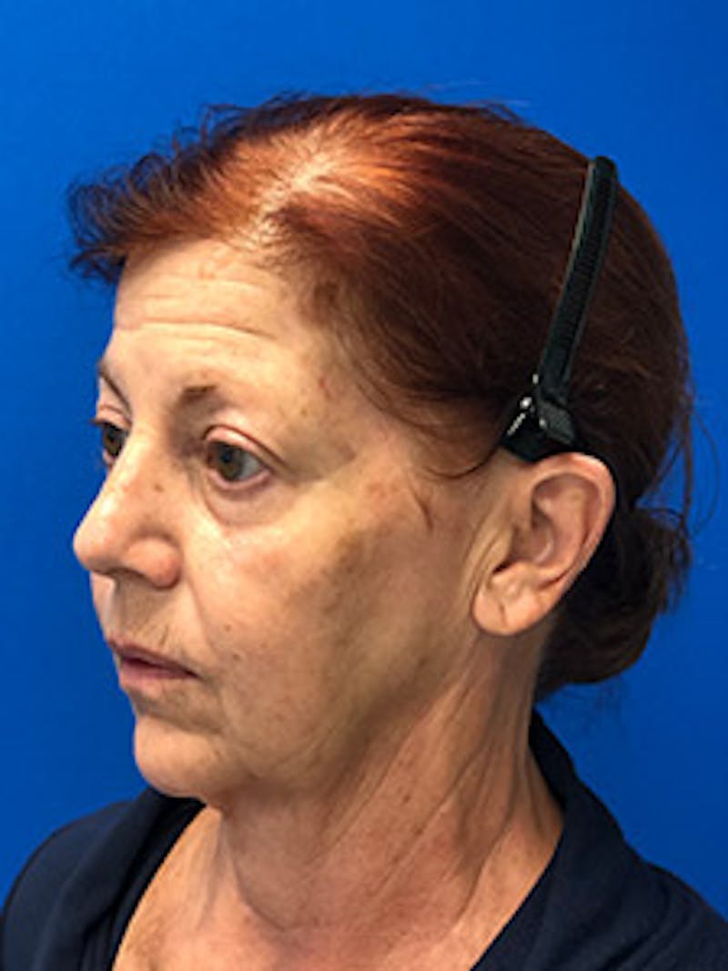 Facelift Before & After Gallery - Patient 122921320 - Image 3