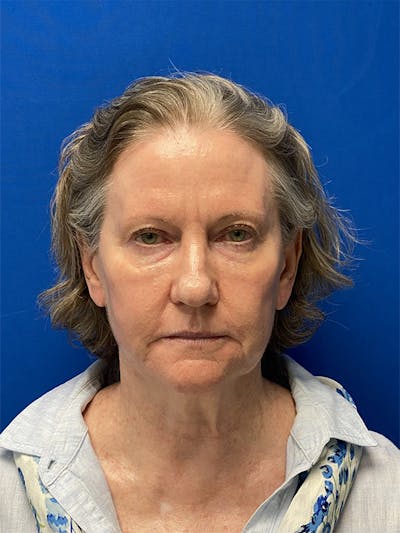 Facelift Before & After Gallery - Patient 122921368 - Image 1