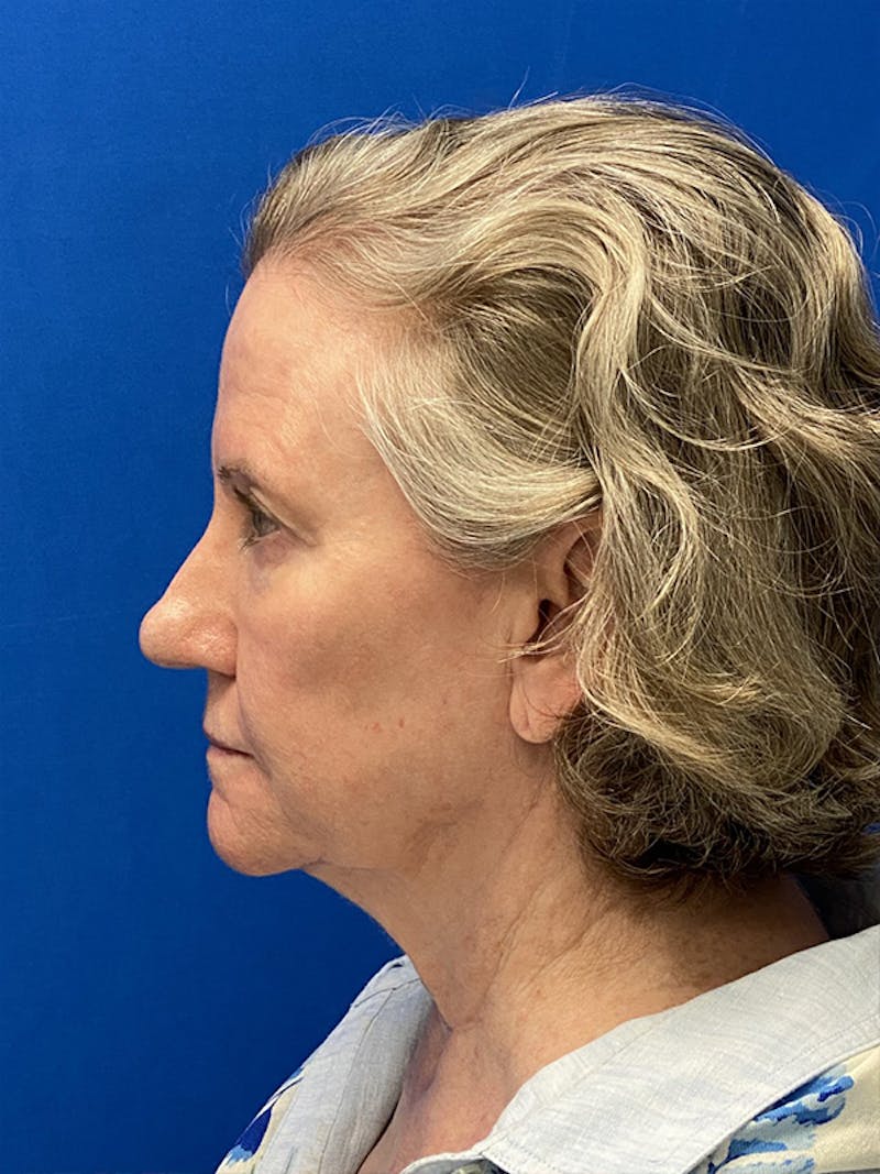 Facelift Before & After Gallery - Patient 122921368 - Image 7