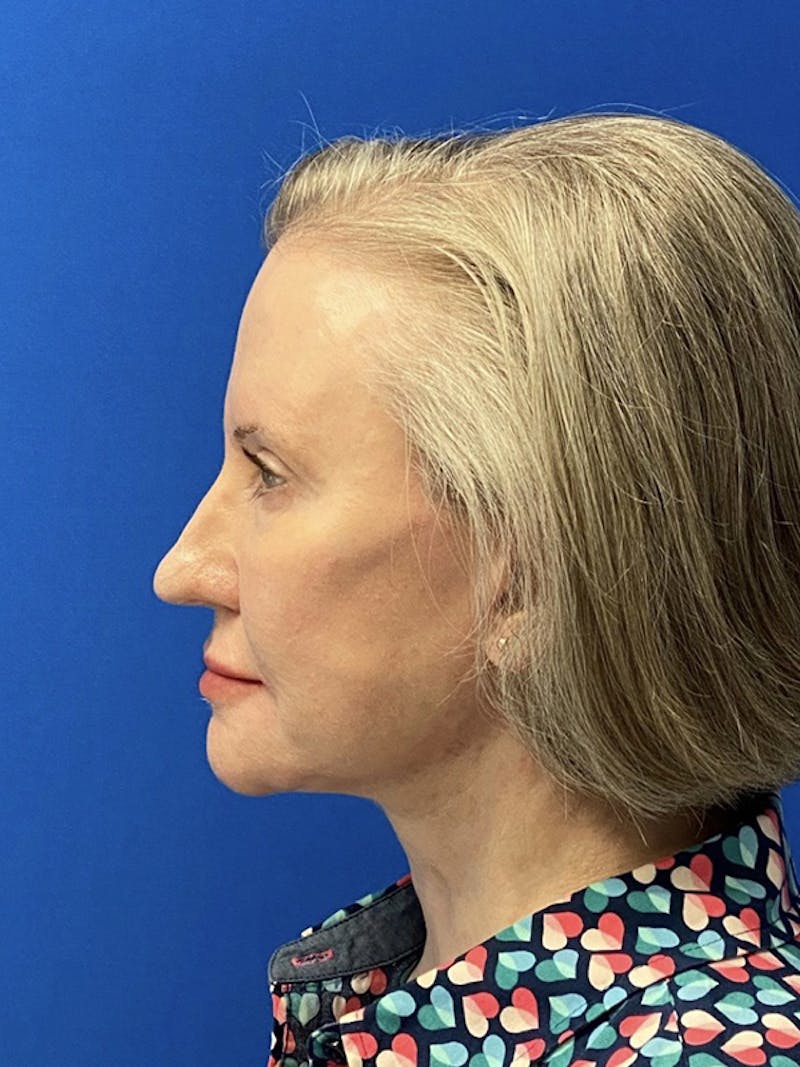 Facelift Before & After Gallery - Patient 122921368 - Image 8