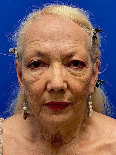 Facelift Before & After Gallery - Patient 122921424 - Image 1