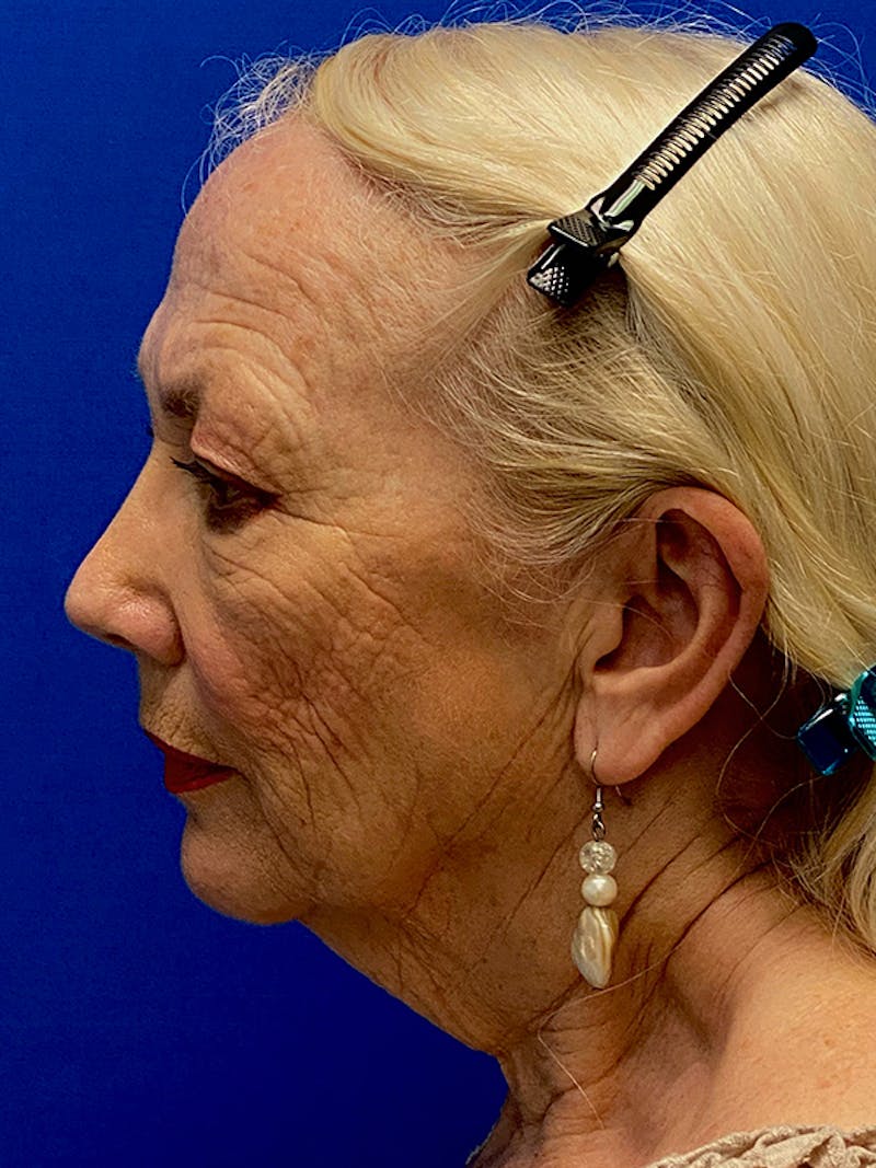 Facelift Before & After Gallery - Patient 122921424 - Image 5
