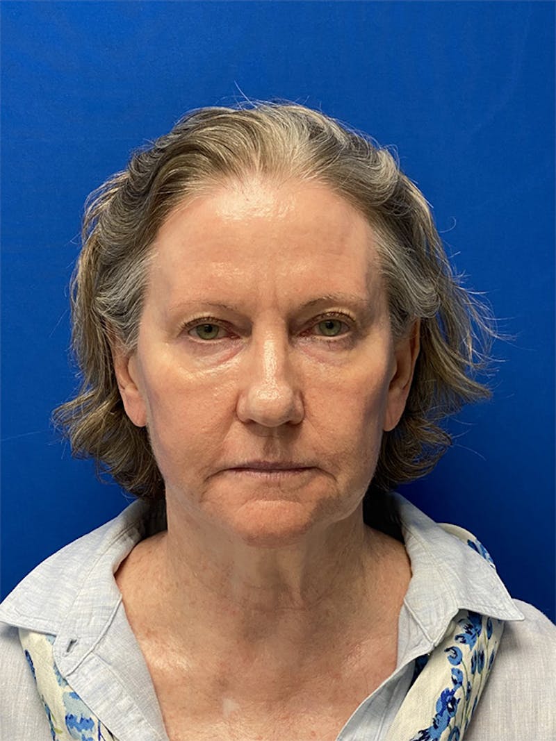 Neck Lift Before & After Gallery - Patient 122921568 - Image 1