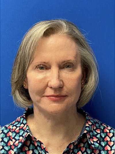 Neck Lift Before & After Gallery - Patient 122921568 - Image 2