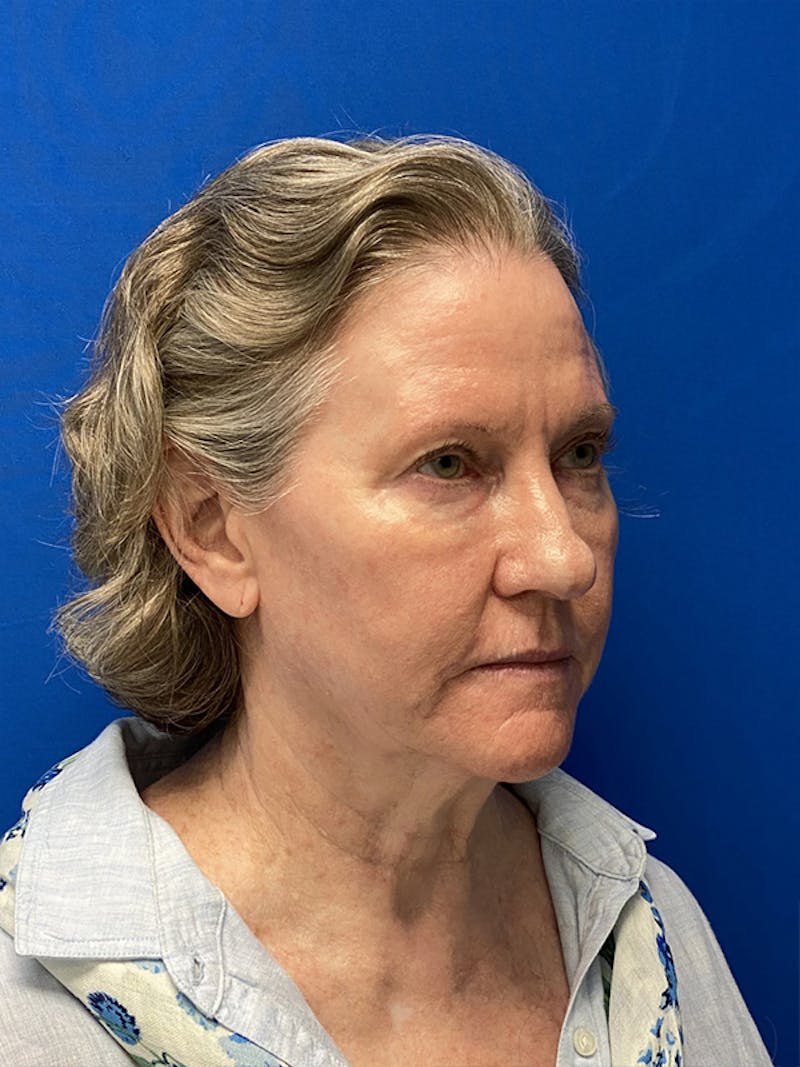 Neck Lift Before & After Gallery - Patient 122921568 - Image 3