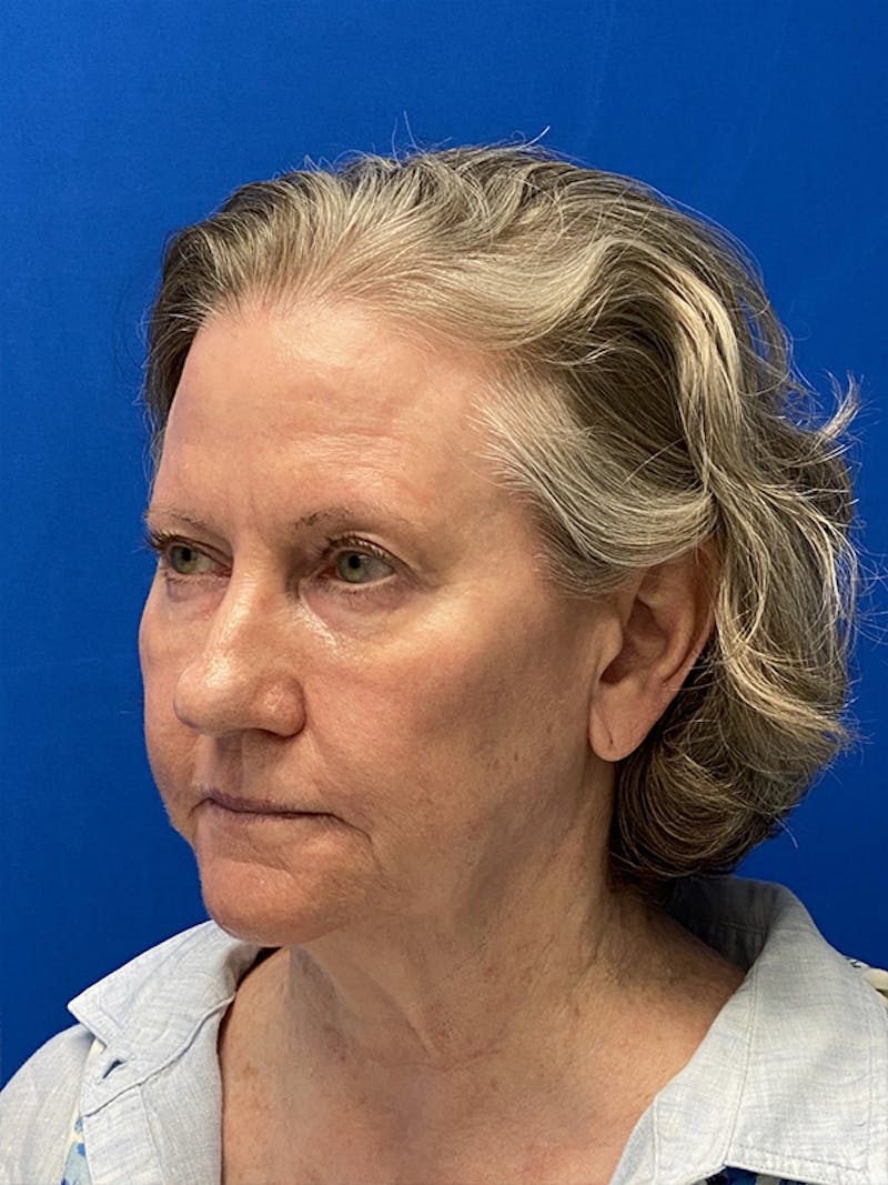 Neck Lift Before & After Gallery - Patient 122921568 - Image 5