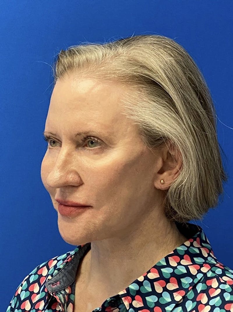 Neck Lift Before & After Gallery - Patient 122921568 - Image 6