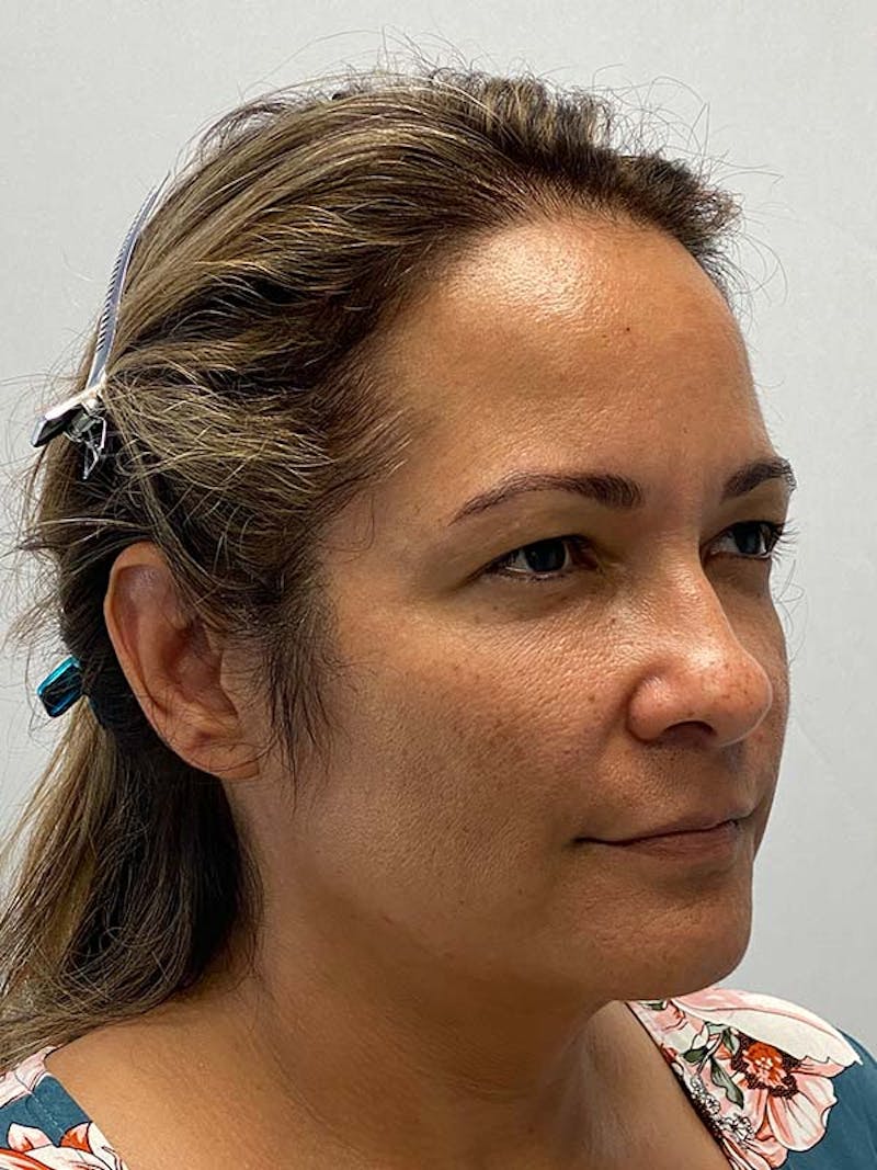Facelift Before & After Gallery - Patient 122921605 - Image 3