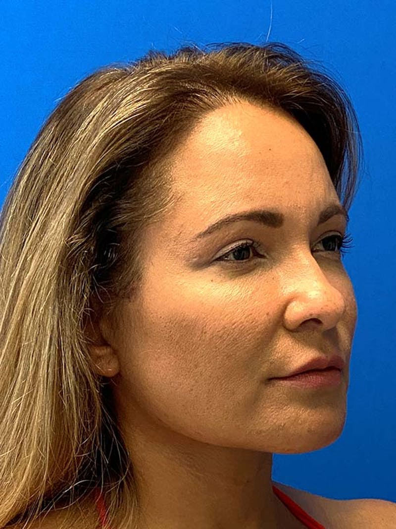 Facelift Before & After Gallery - Patient 122921605 - Image 4