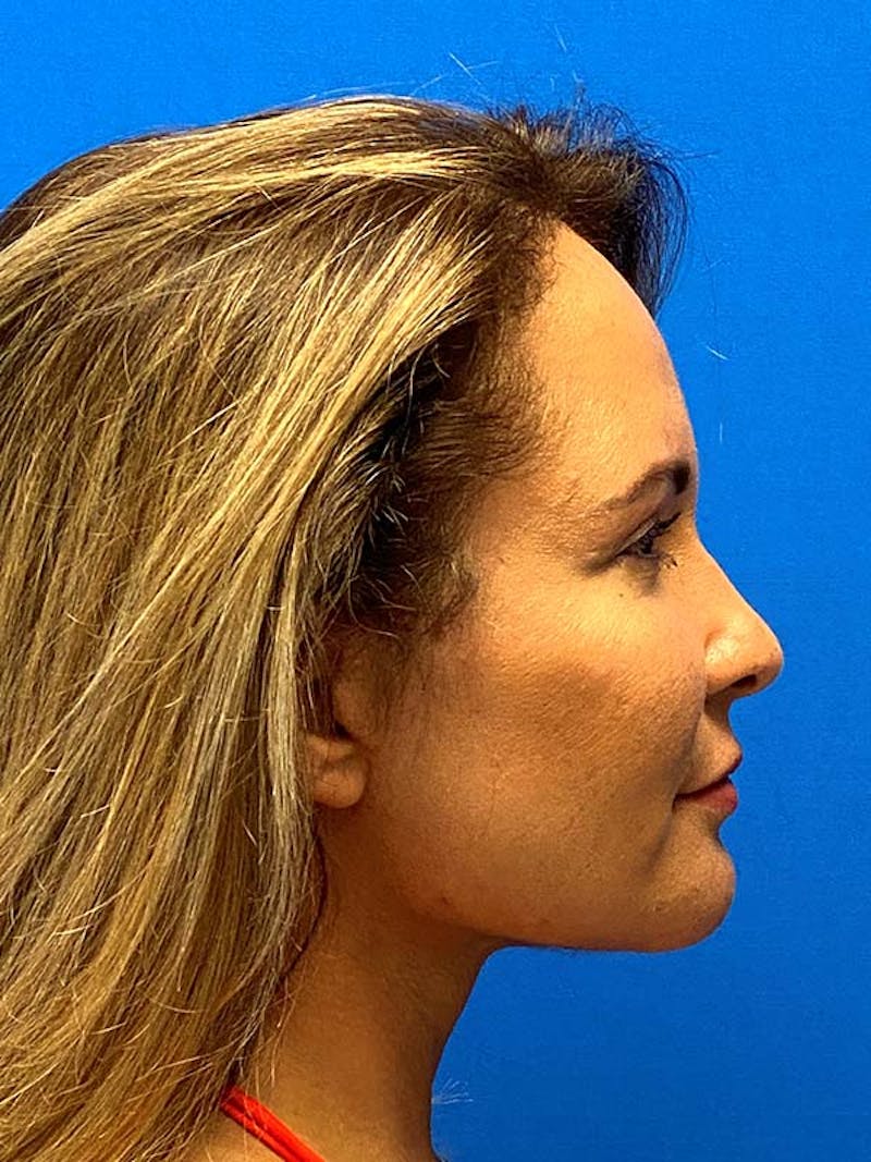 Facelift Before & After Gallery - Patient 122921605 - Image 6