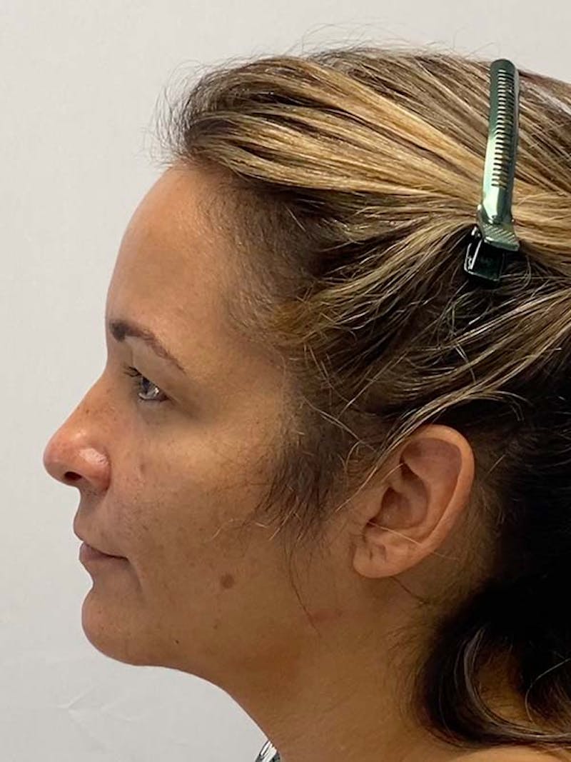 Facelift Before & After Gallery - Patient 122921605 - Image 9