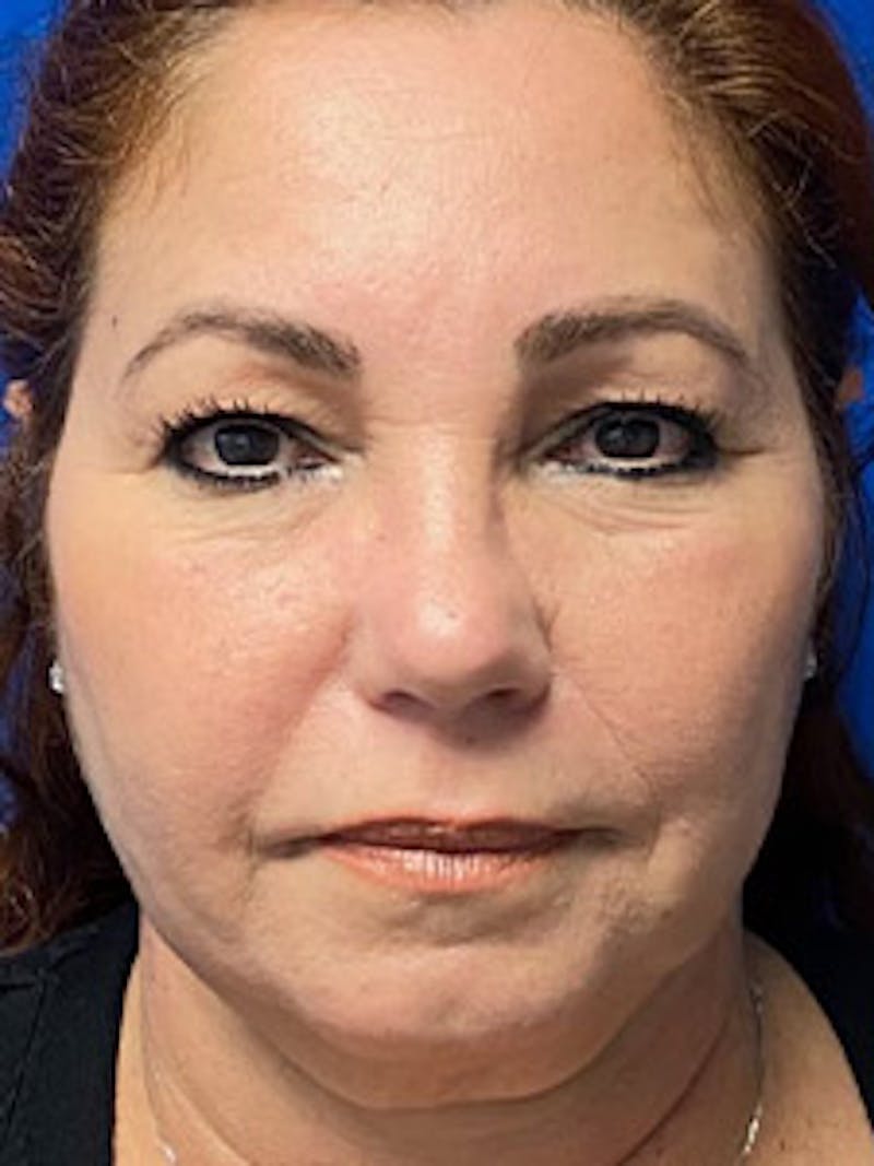 Facelift Before & After Gallery - Patient 122921627 - Image 1