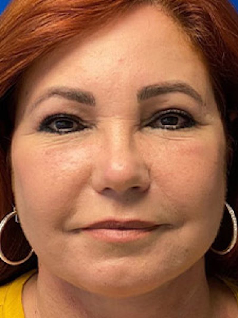Facelift Before & After Gallery - Patient 122921627 - Image 2