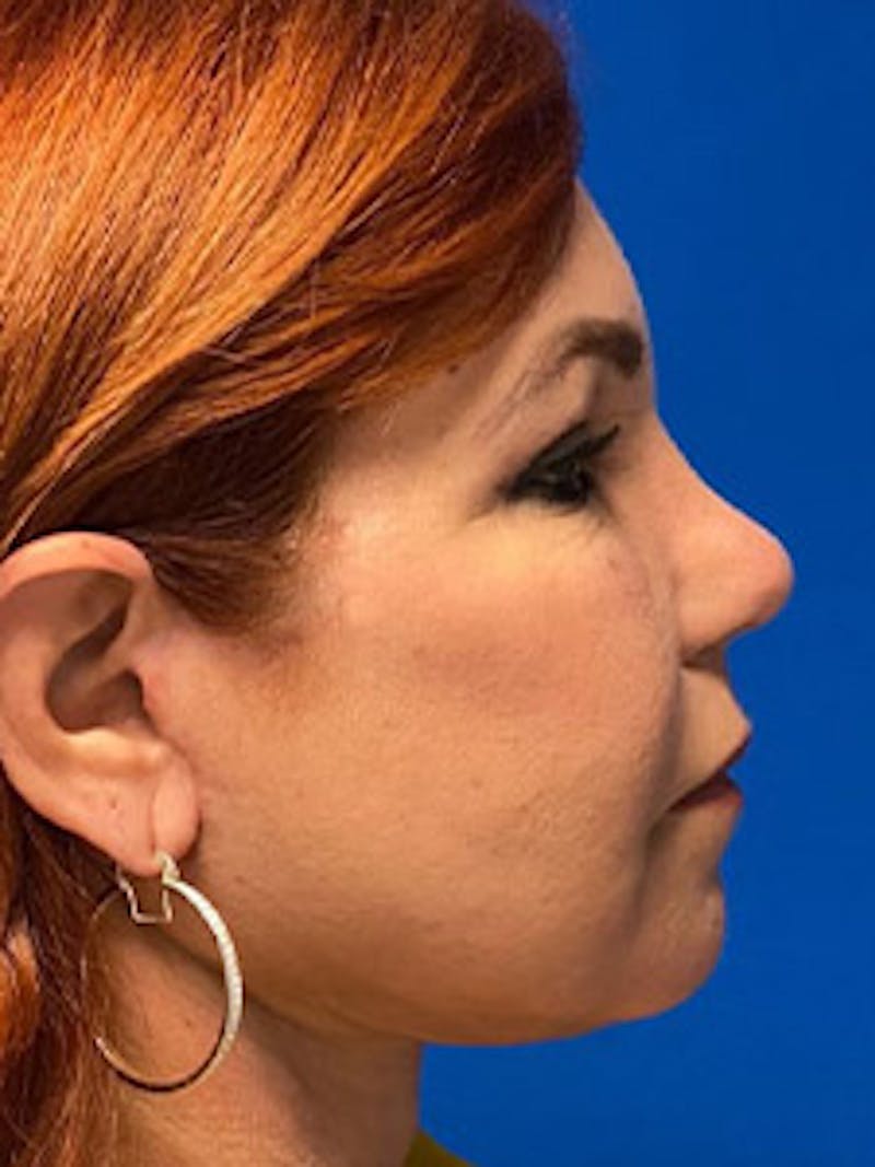 Facelift Before & After Gallery - Patient 122921627 - Image 4