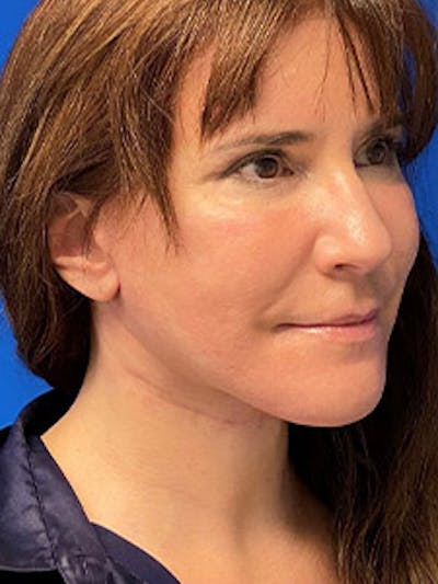 Facelift Before & After Gallery - Patient 122921646 - Image 2