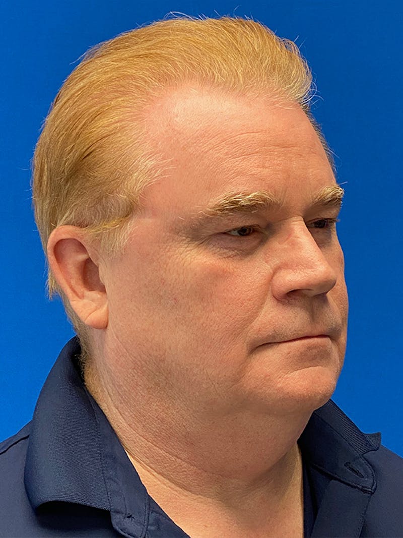 Neck Lift Before & After Gallery - Patient 122921700 - Image 3