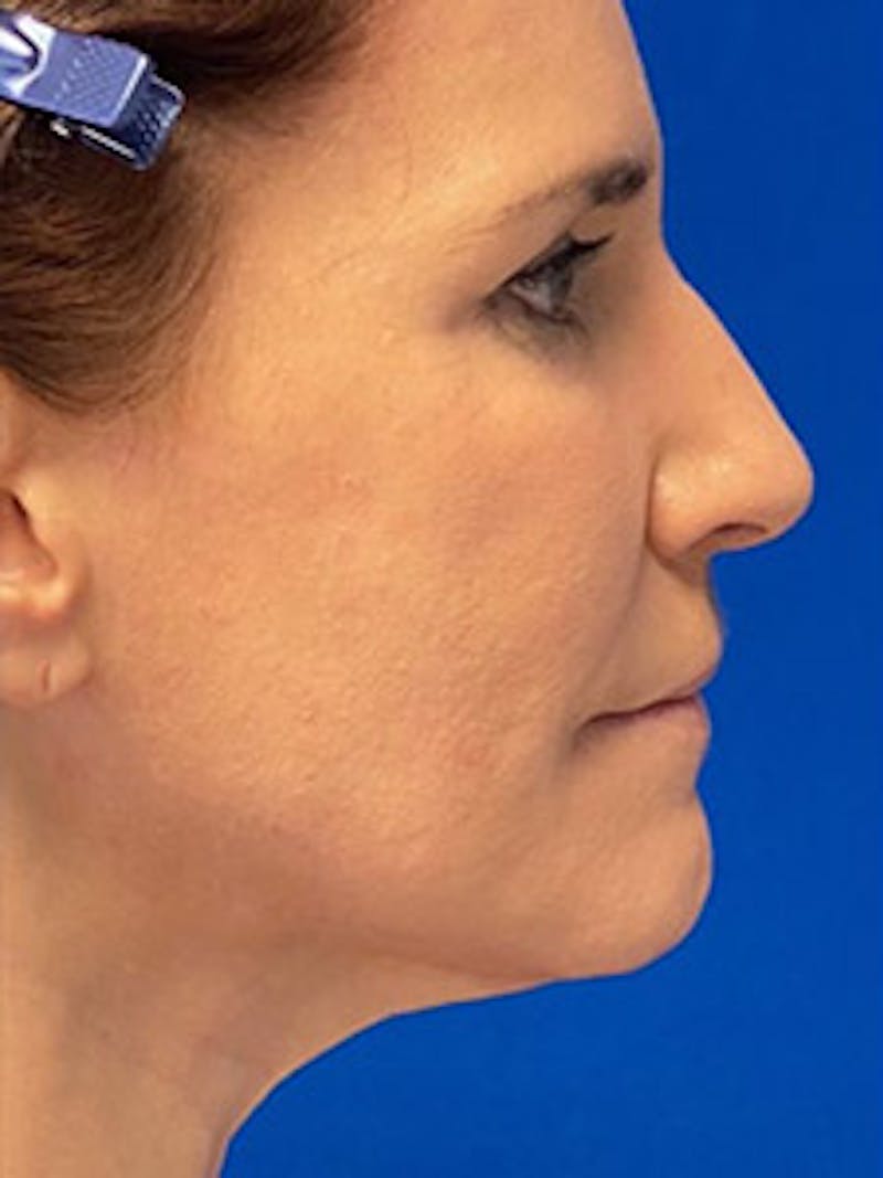Facelift Before & After Gallery - Patient 122921646 - Image 3