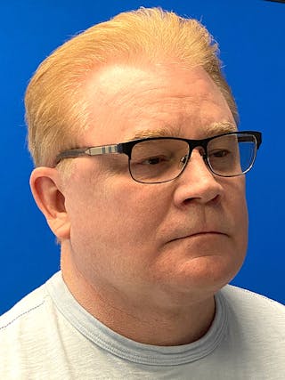 Neck Lift Before & After Gallery - Patient 122921700 - Image 4