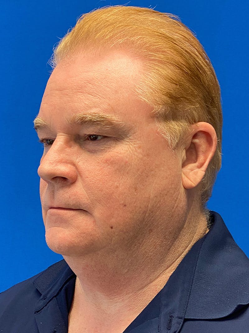 Neck Lift Before & After Gallery - Patient 122921700 - Image 5