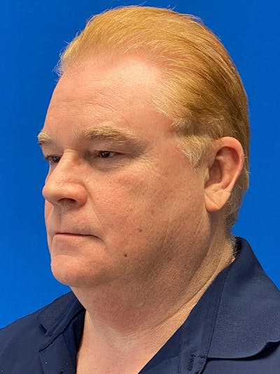 Neck Lift Before & After Gallery - Patient 122921700 - Image 1