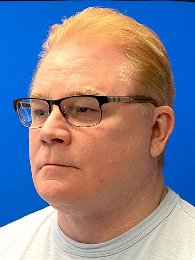 Neck Lift Before & After Gallery - Patient 122921700 - Image 2