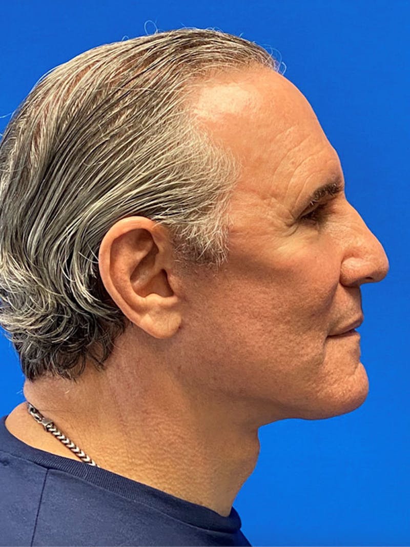 Neck Lift Before & After Gallery - Patient 122921766 - Image 6