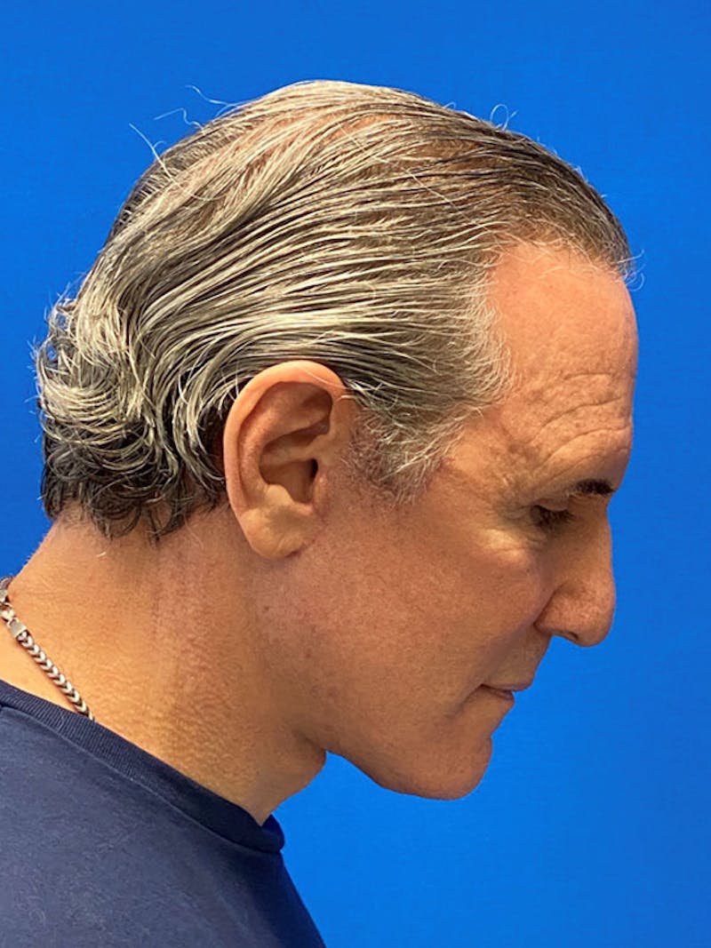 Neck Lift Before & After Gallery - Patient 122921766 - Image 8
