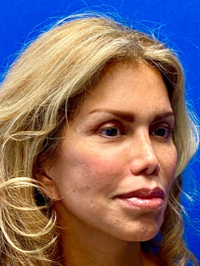 Neck Lift Before & After Gallery - Patient 122921812 - Image 2